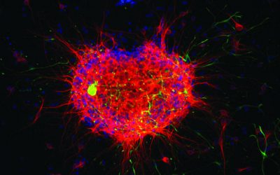 Heart conditions linked with an increased risk of dementia